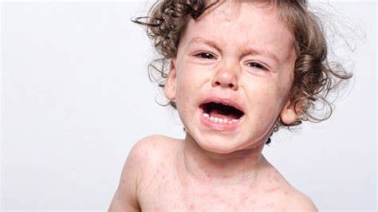 儿童皮肤过敏怎么办 什么药能治疗宝宝皮肤过敏-皮肤过敏治疗-复禾健康