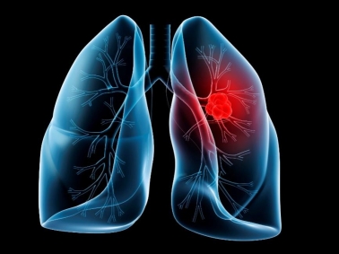 Research Identifies Genetic Alterations in Lung Cancers That Help Select Treatment; May Improve ...