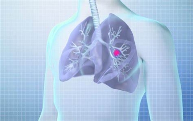 肺癌筛查 | 低剂量计算机断层扫描（LDCT）-健康视频-搜狐视频